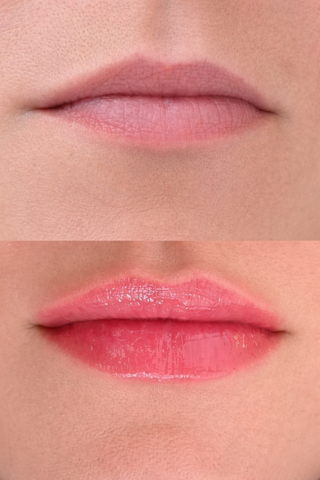 Before and after photo showing subtle lip filler treatment enhancing lip definition and structure without an overfilled appearance.