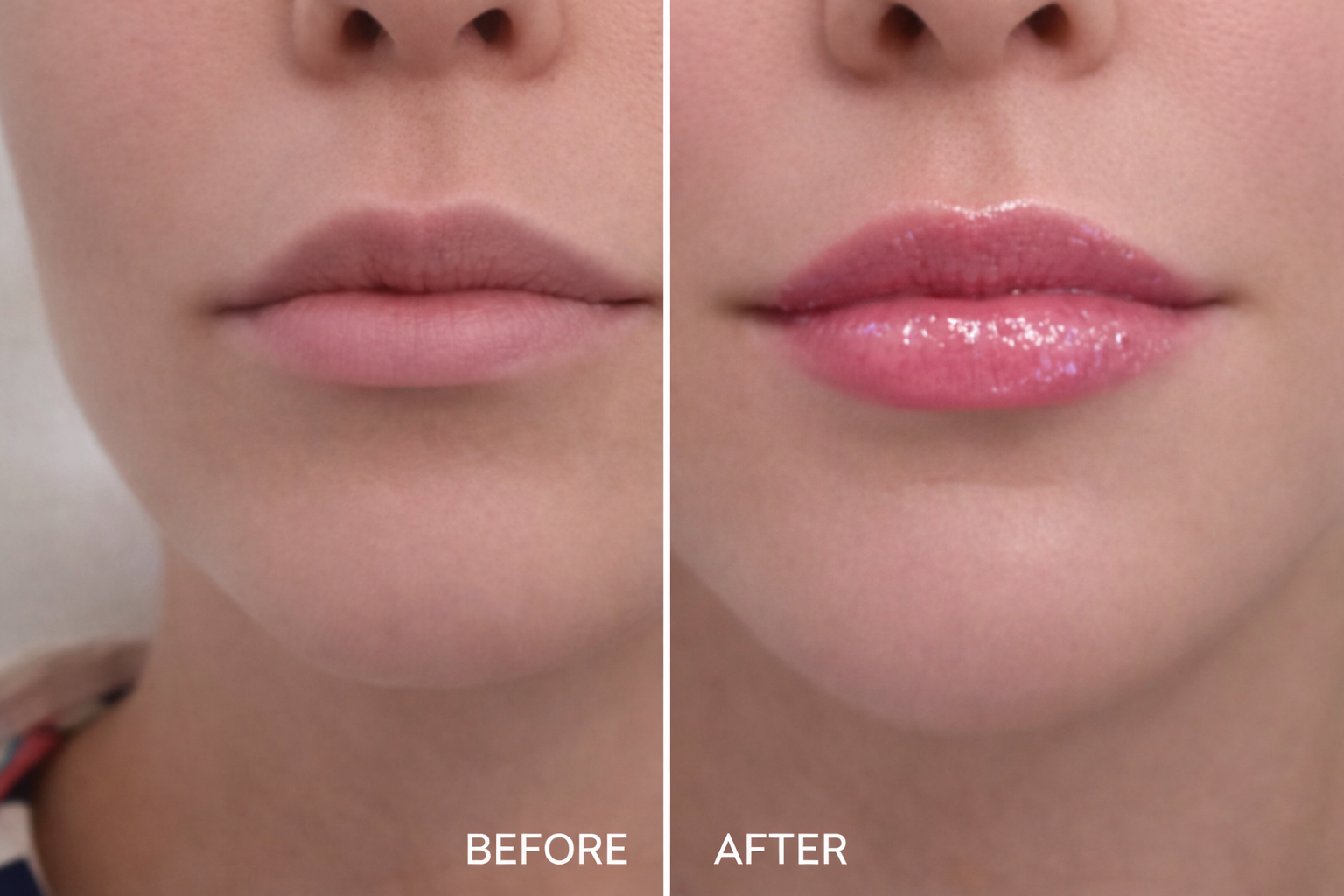 Close-up image showing a person's lips before and after lip filler treatment. The left side labeled 'BEFORE' shows lips without filler, and the right side labeled 'AFTER' shows fuller lips after the treatment.