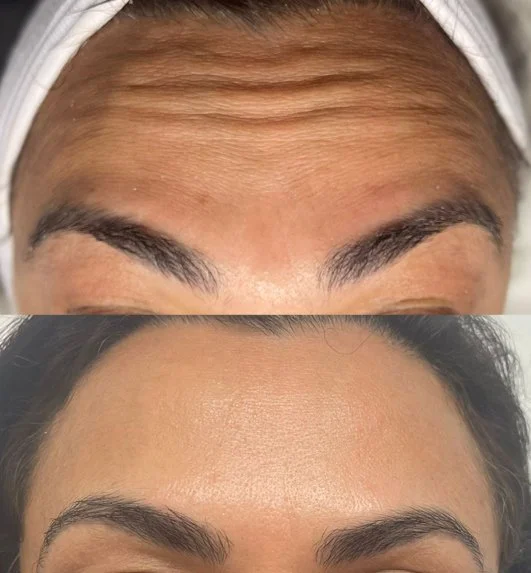 Close-up of a woman's forehead showing before and after Botox Anti-Wrinkle treatment for forehead lines, smoothing horizontal wrinkles while preserving natural facial expression. Performed at SkinWell Aesthetics Boutique in Notting Hill, London.