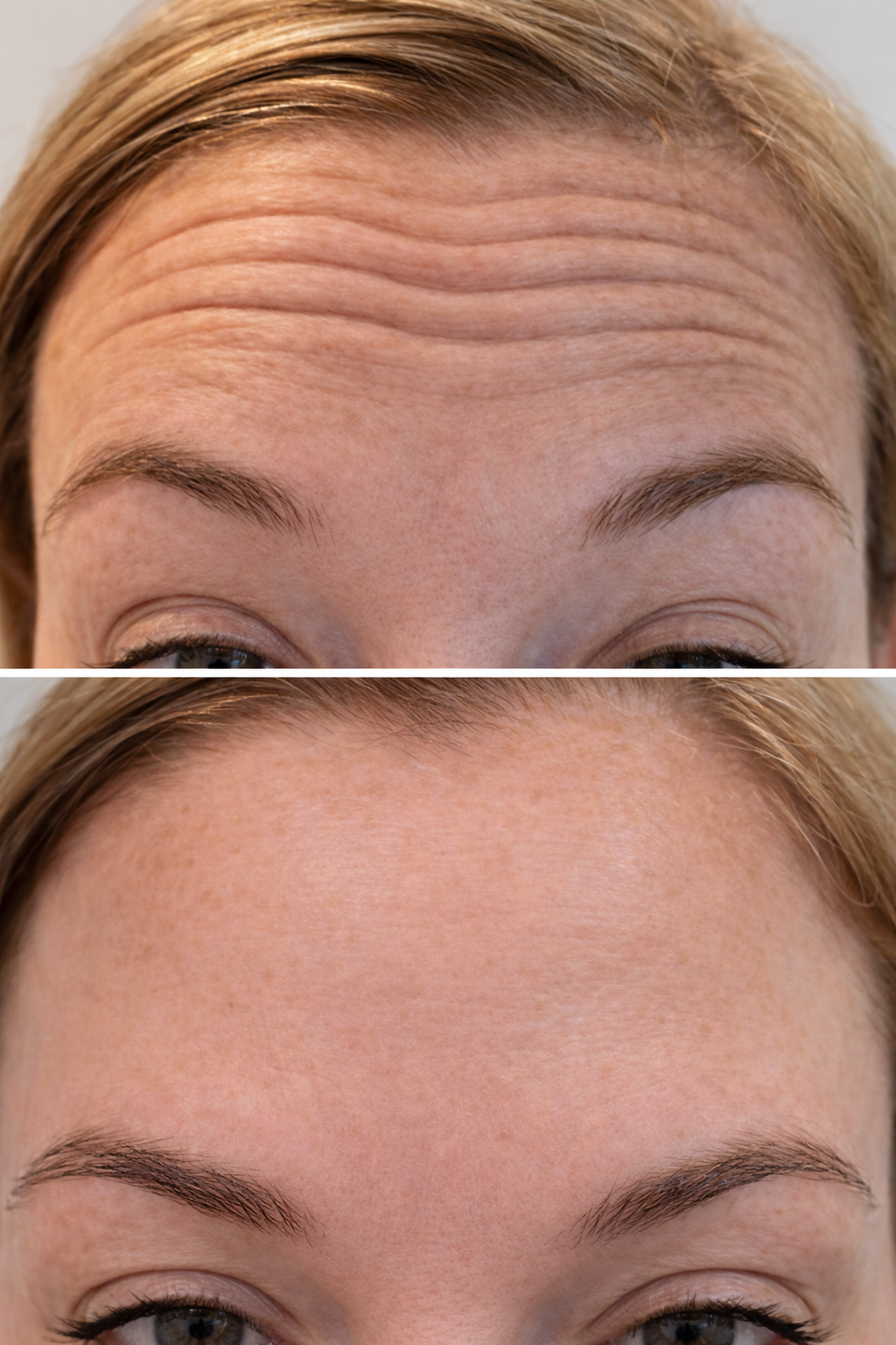 Close-up of a woman's forehead with visible wrinkles in the upper part of the image, and smooth, wrinkle-free skin in the lower part indicating a before and after comparison of forehead botox treatment.