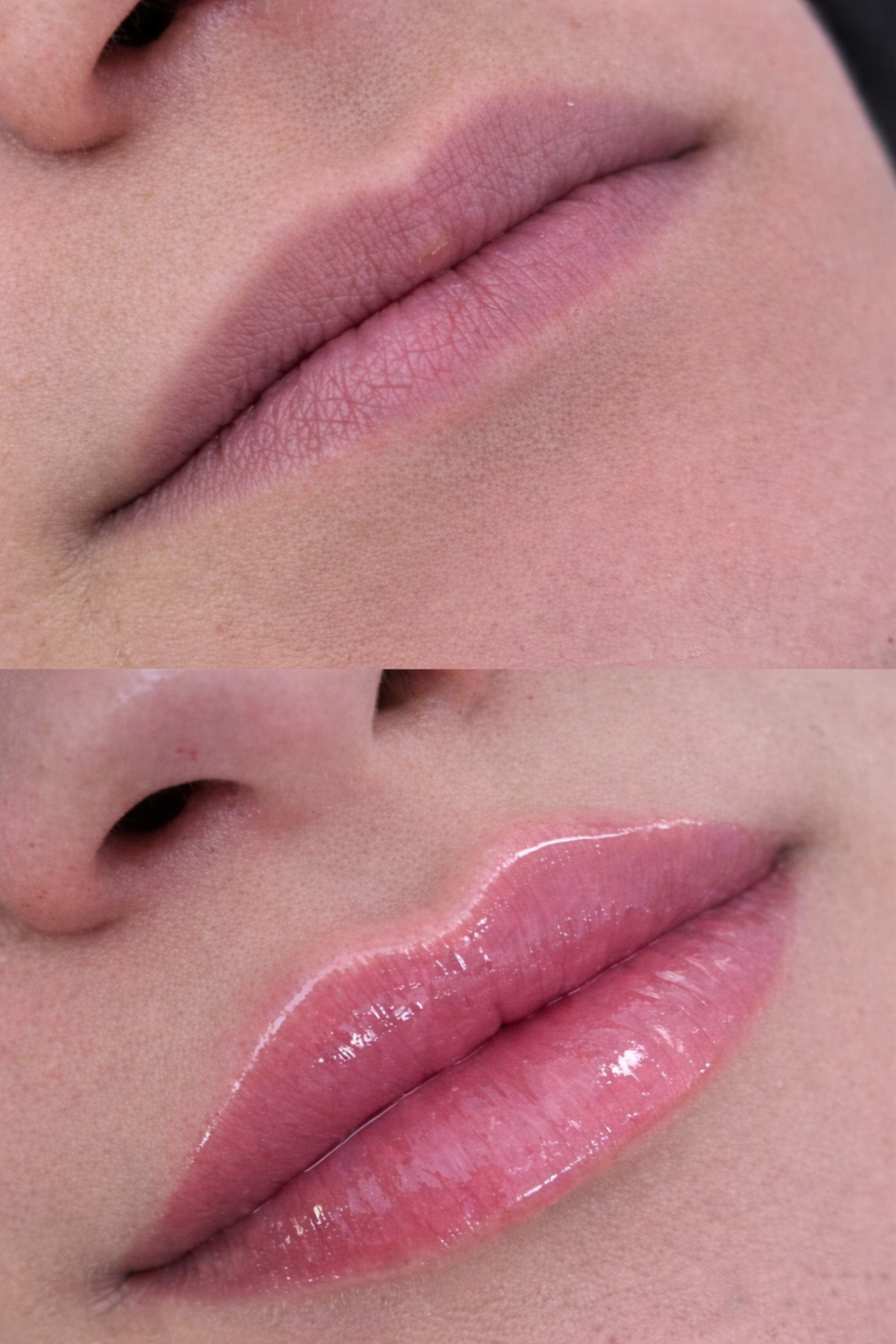 Close-up of a person’s lips before and after lip filler focusing on defining the cupid’s bow and restoring gentle volume for a refreshed yet natural look.