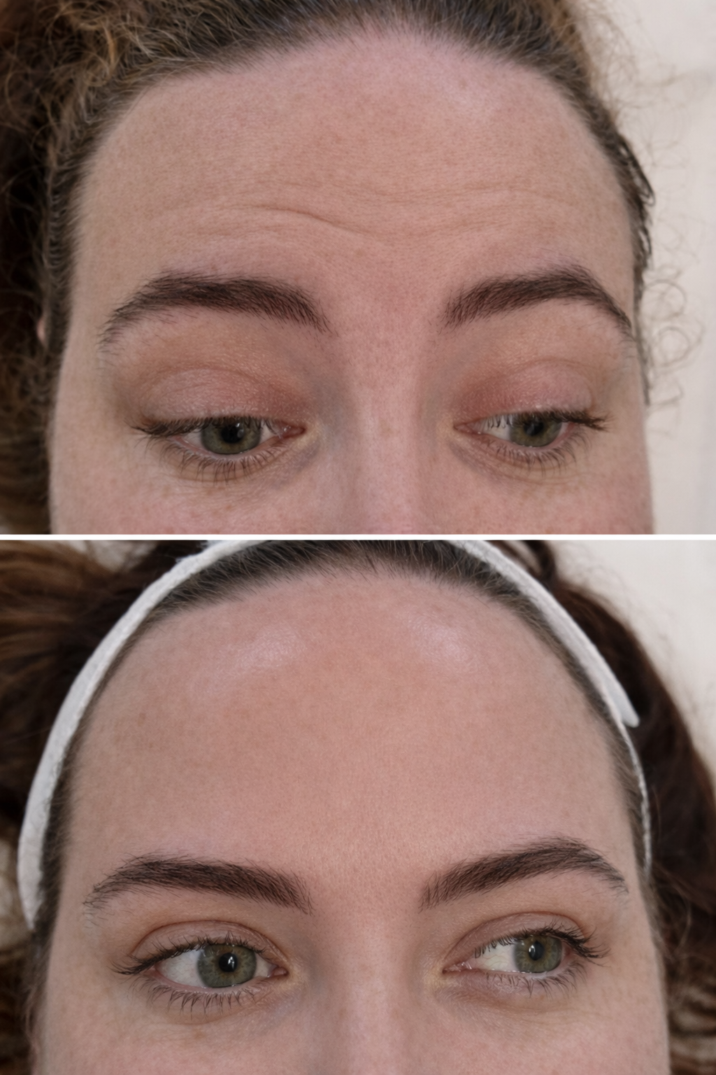 Close-up of a woman's face showing a before and after forehead Botox results showing softened wrinkles and smoother skin while preserving natural facial expression.