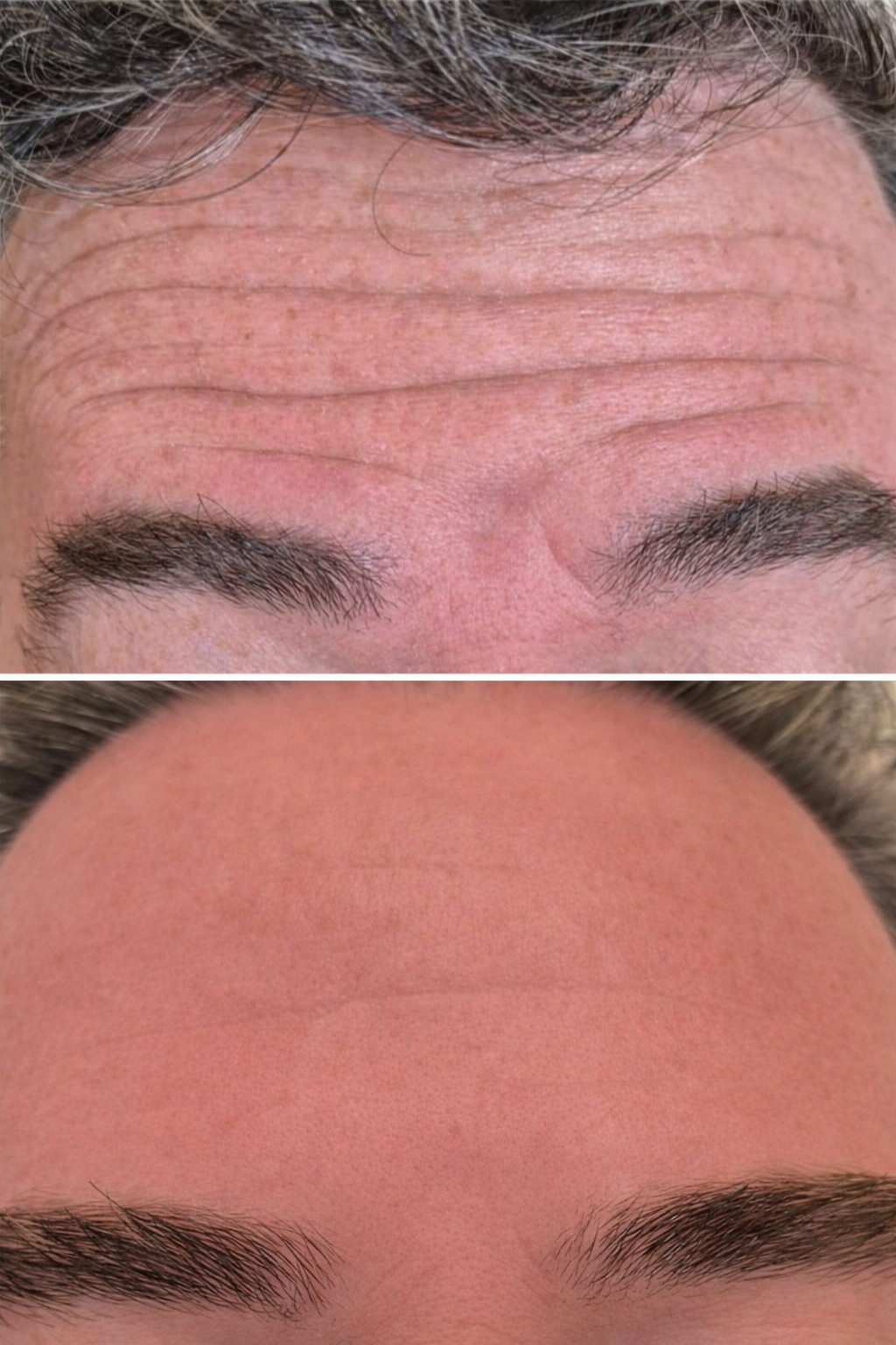 Close-up images of a person's forehead before and after botox treatment showing reduction of wrinkles and smoother skin.