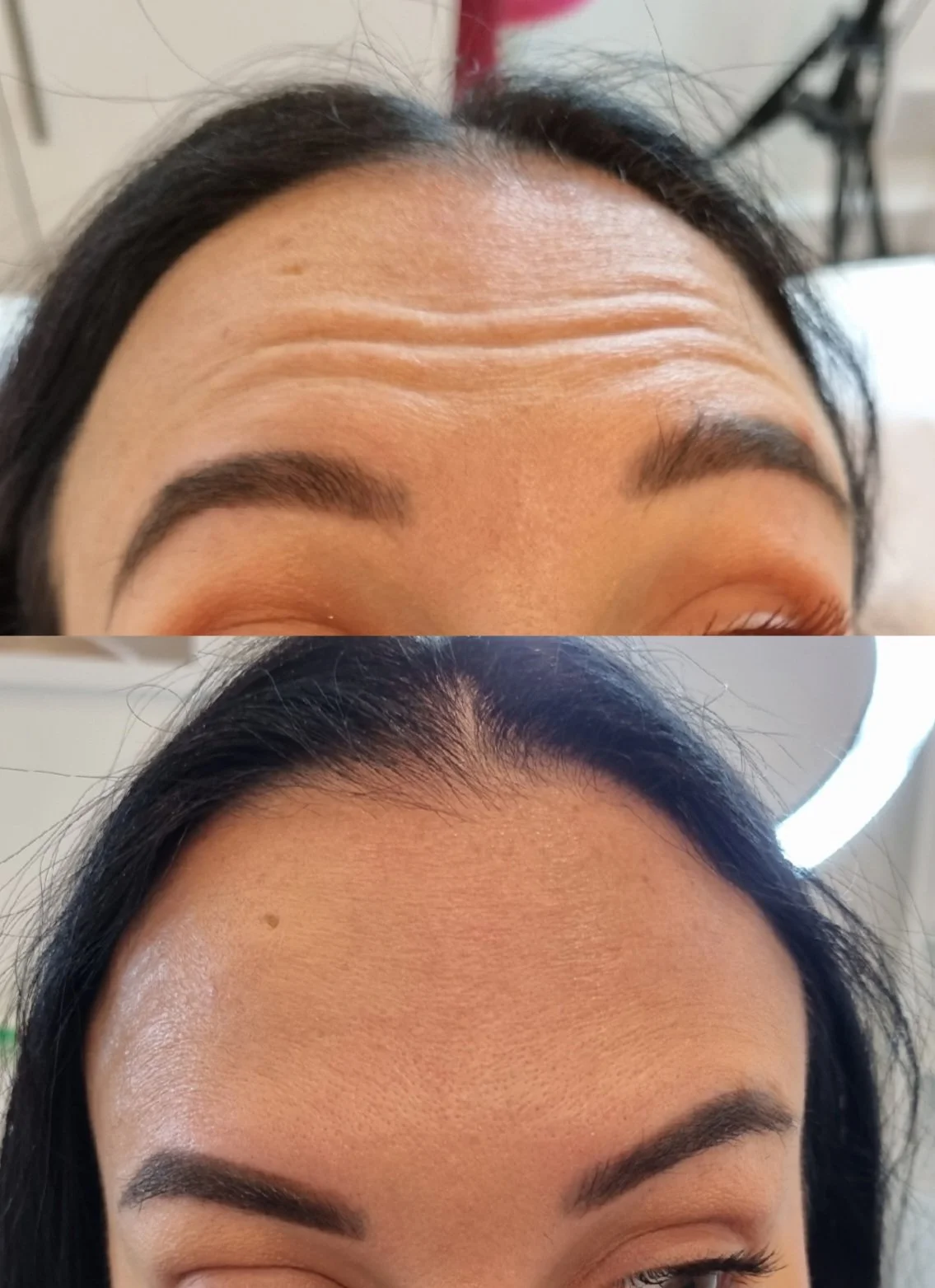 Before and after images of a woman after Botox Anti-Wrinkle treatment for forehead lines, smoothing horizontal wrinkles while preserving natural facial expression. Performed at SkinWell Aesthetics Boutique in Notting Hill, London.