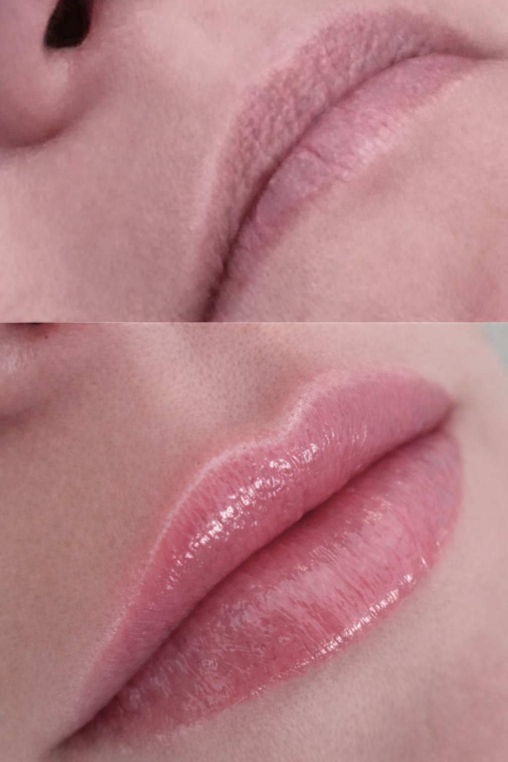 Close-up of a woman's lips, showing before and after lip filler injections, showing the results of a fuller lips, enhancing natural lip volume and hydration.