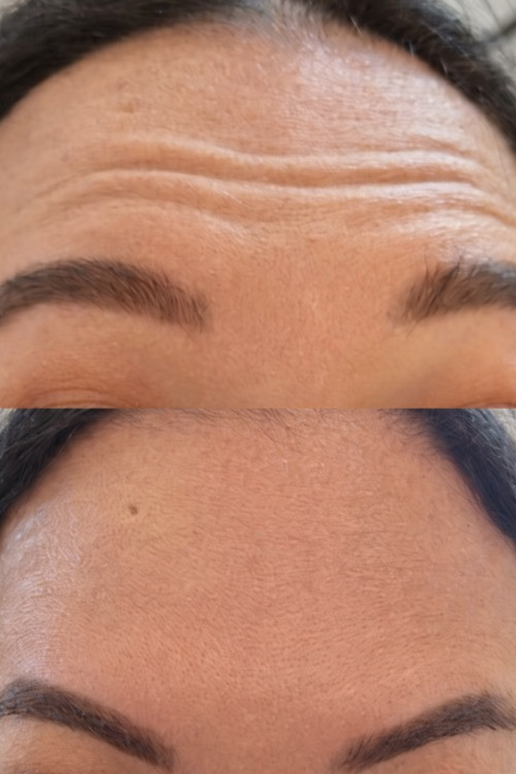Close-up of a person's forehead showing before and after forehead Botox treatment softening fine lines and wrinkles for a refreshed, natural look without a frozen appearance.