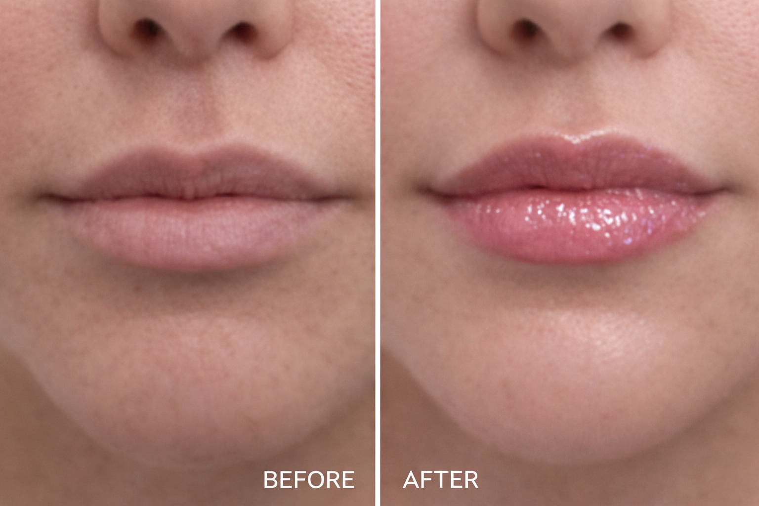 Close-up of a woman's lips before and after lip filler focusing on defining the cupid’s bow and restoring gentle volume for a refreshed yet natural look.