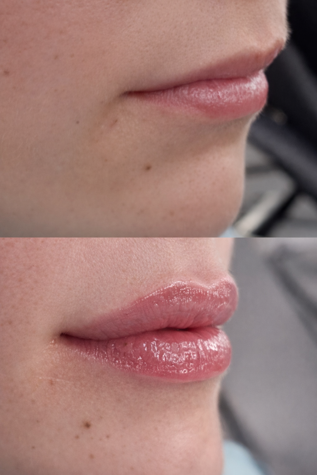 Close-up of a person's lips before and after cosmetic lip enhancement treatment.