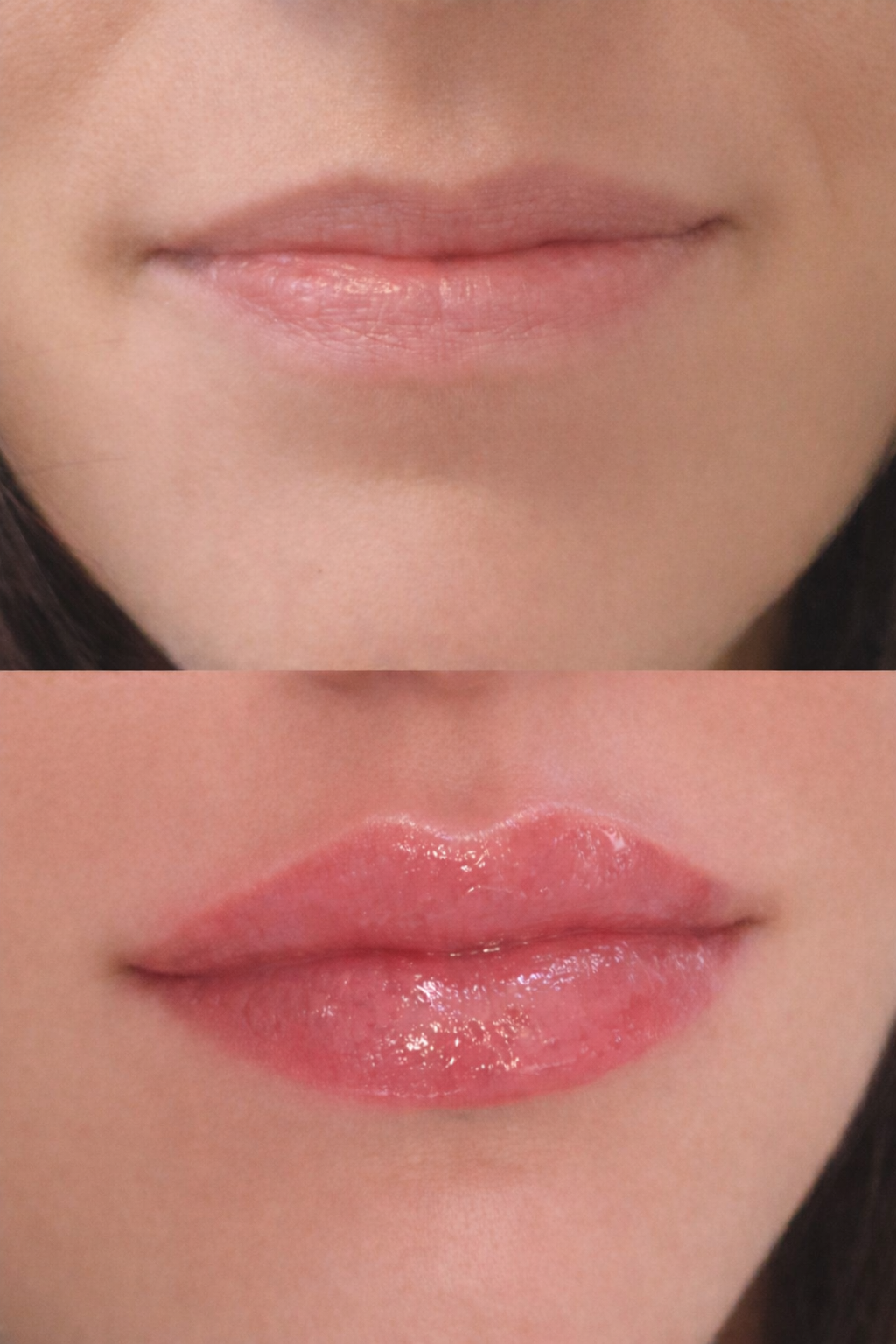 Close-up of a person's lips, showing before and after Russian lip filler technique designed to lift the cupid’s bow and create elegant, defined lips without excessive volume.