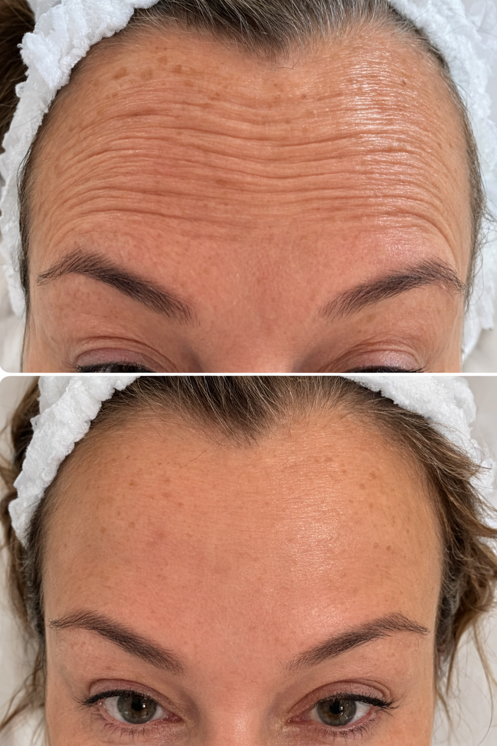 Before and after images showing a woman's forehead and face, with the top image displaying wrinkles and fine lines on the forehead, and the bottom image showing a smooth, wrinkle-free forehead after treatment.