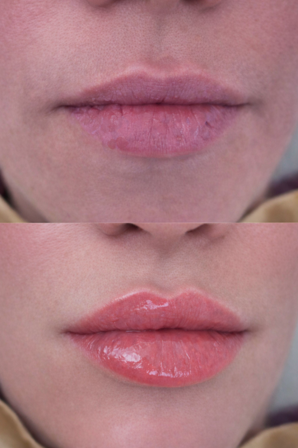 Close-up of a person's lips before and after lip filler treatment, showing results designed to restore youthful volume and smooth lip texture while preserving facial harmony.