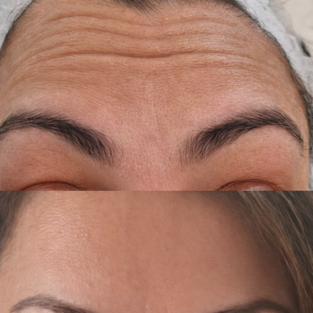 Close-up of a person's forehead and eyebrows, showing before and after Botox treatment reducing dynamic forehead wrinkles caused by repeated muscle movement.