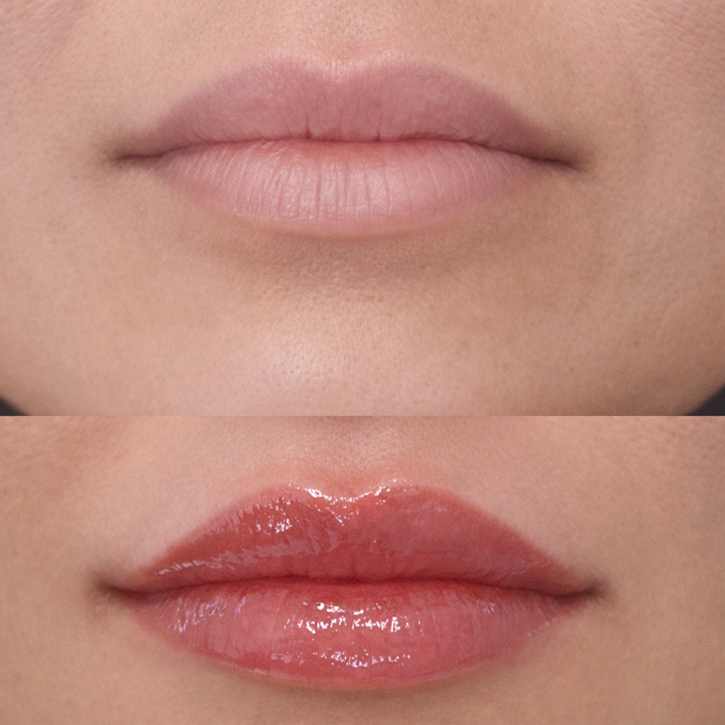 Close-up of lips before and after lip filler treatment showing subtle volume and improved lip definition while maintaining a natural shape. Performed at SkinWell Aesthetics Boutique in Notting Hill, London.