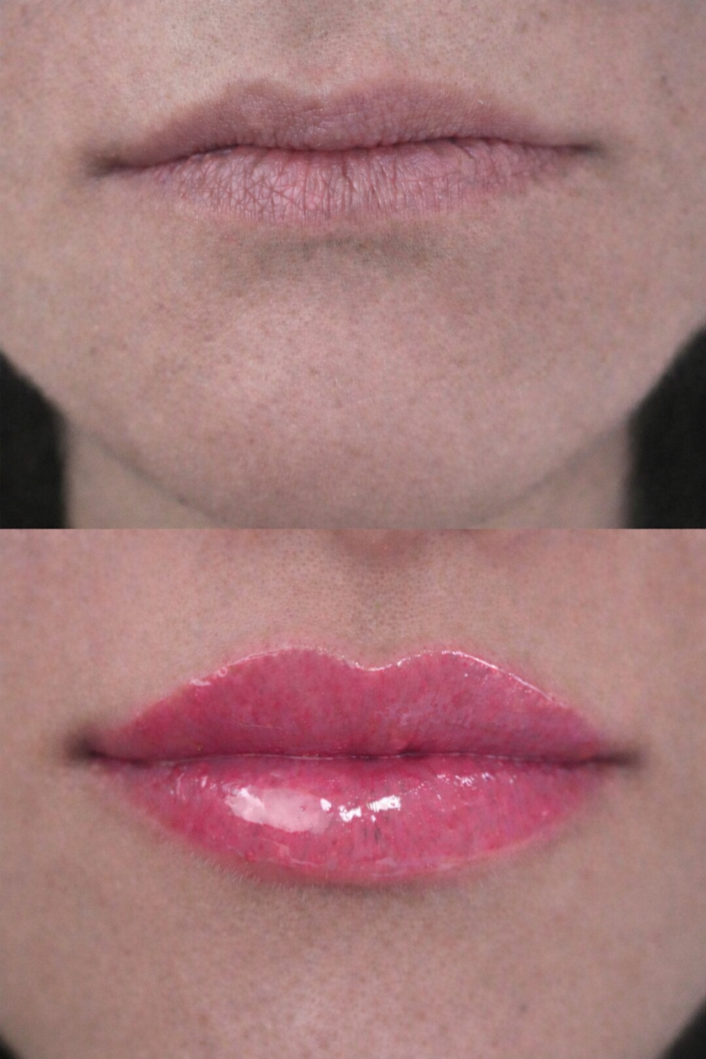 Close-up of a woman's lips showing natural lip filler results designed to restore youthful volume and smooth lip texture while preserving facial harmony.