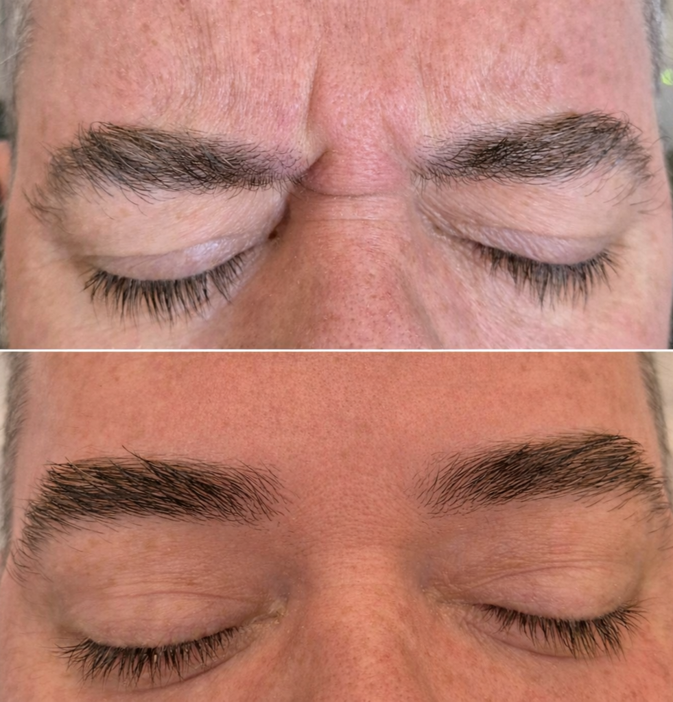 Close-up of a person's glabella before and after botox treatment, showing smoother results.