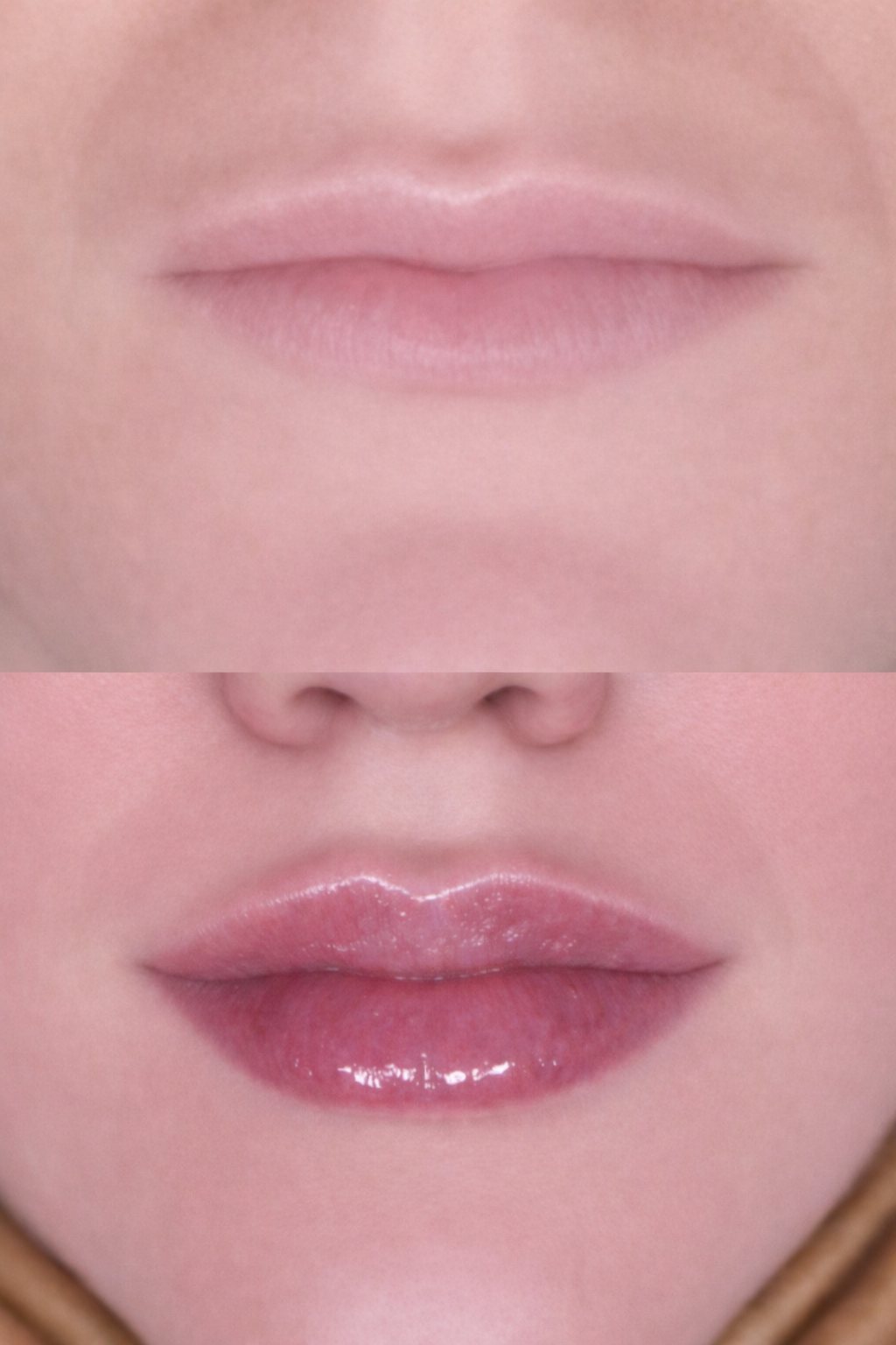 Comparison of lips before and after lip filler enhancement, showing dull lips at the top and enhanced and more defined lips at the bottom.