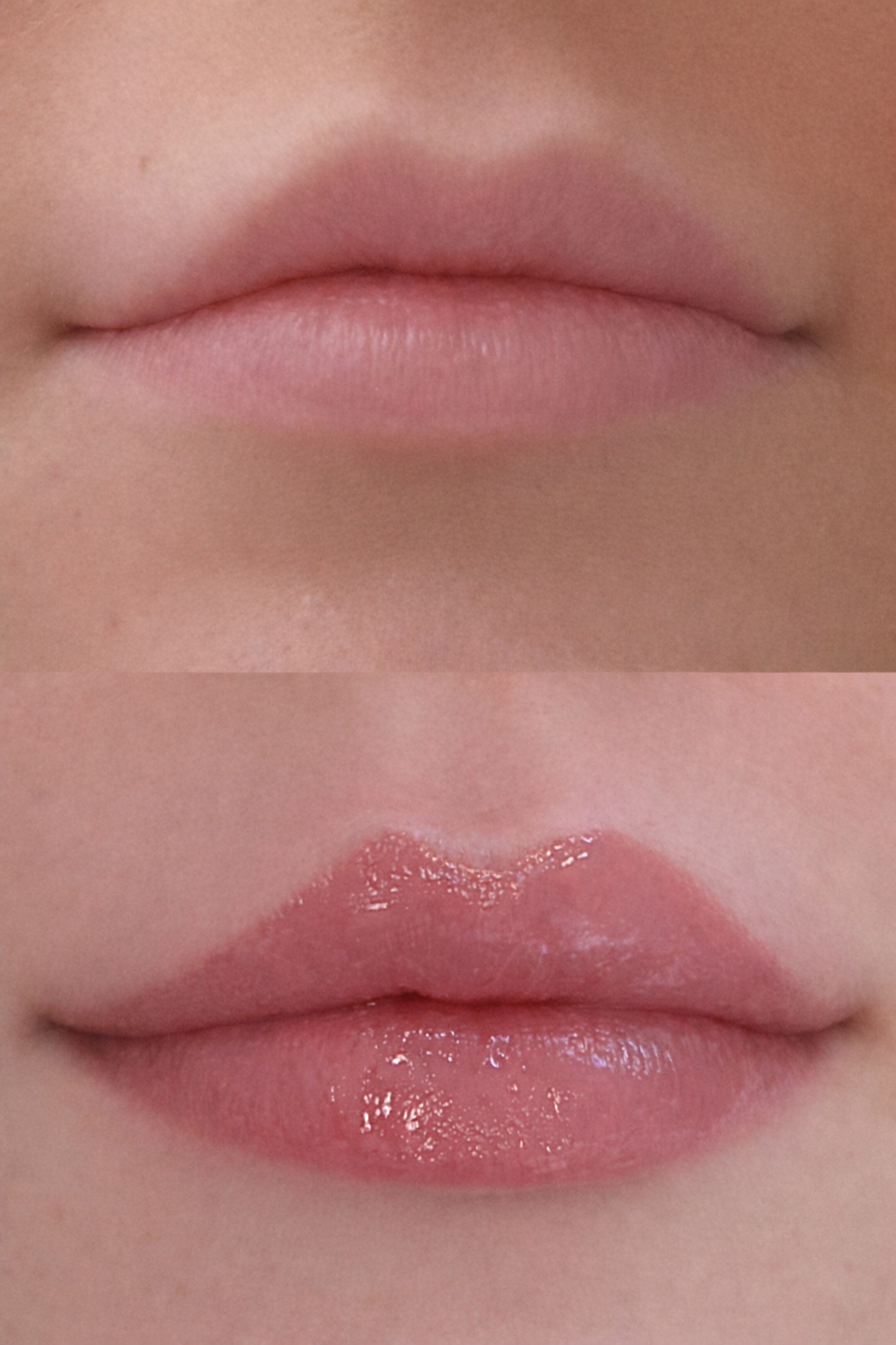 Close-up of a person's lips, showing a before and after lip filler treatment. The top image shows natural lips, while the bottom image shows improved lip definition maintaining a natural shape.