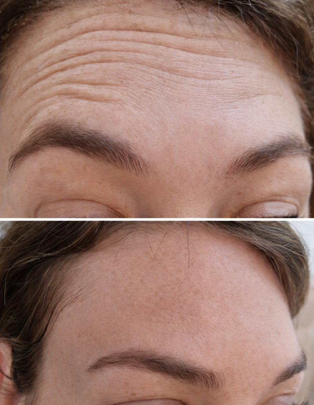 Close-up of a woman's forehead showing before and after images of Botox treatment. The top part shows visible wrinkles on the forehead, while the bottom part shows the smoother, wrinkle-free skin after treatment.