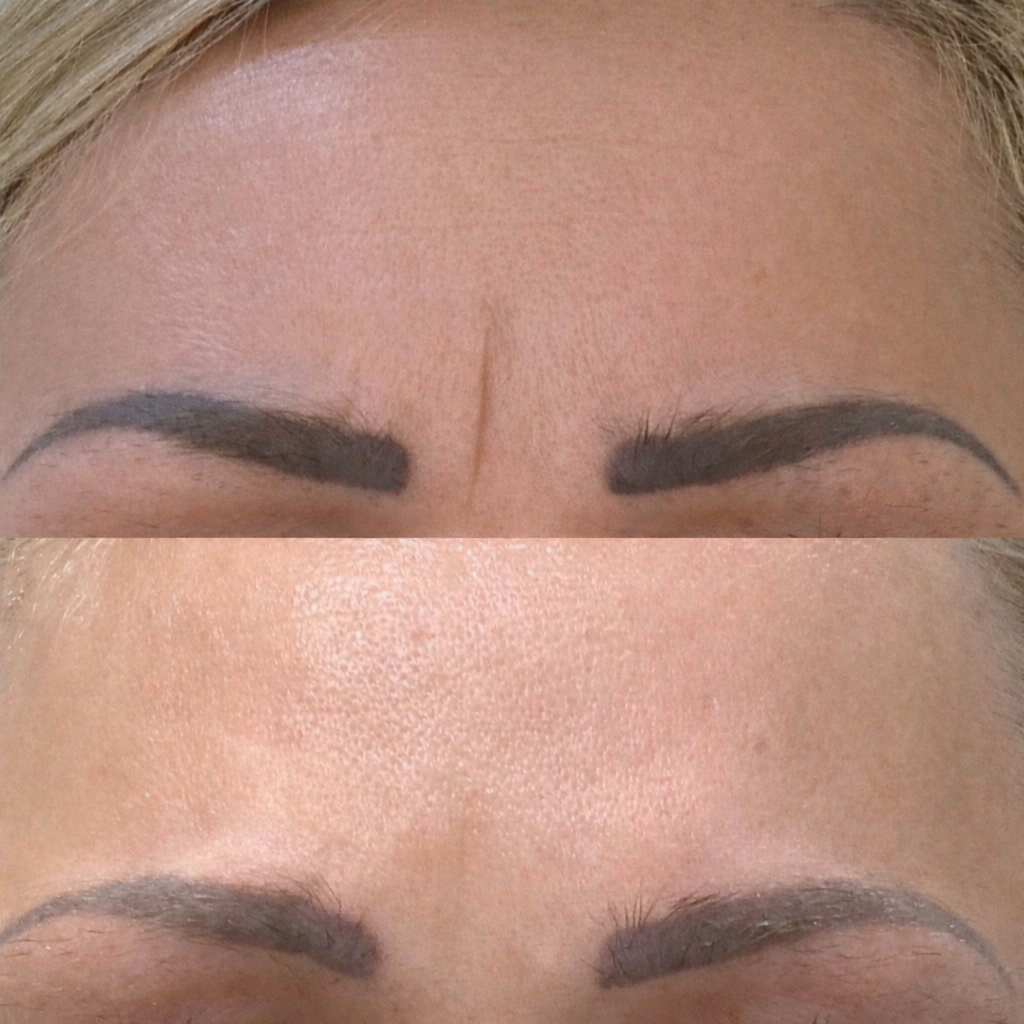 Before and after image showing botox Anti-Wrinkle treatment improving forehead skin texture and softening lines for a naturally refreshed look.