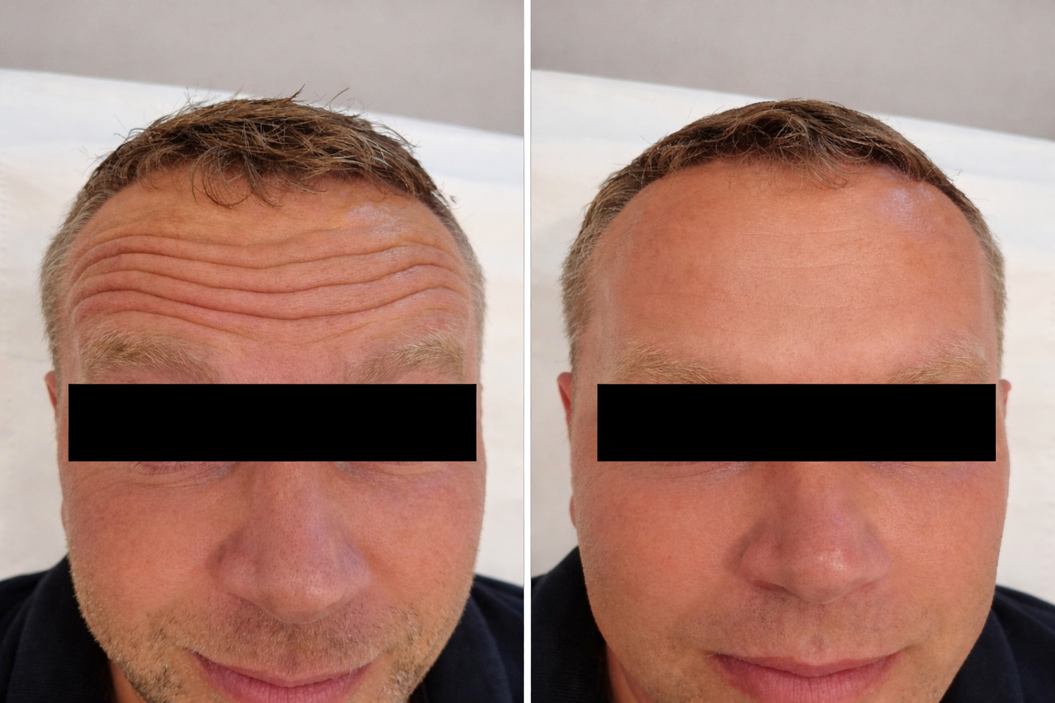 Before and after images of a man's forehead botox results showing softened wrinkles and smoother skin while preserving natural facial expression.