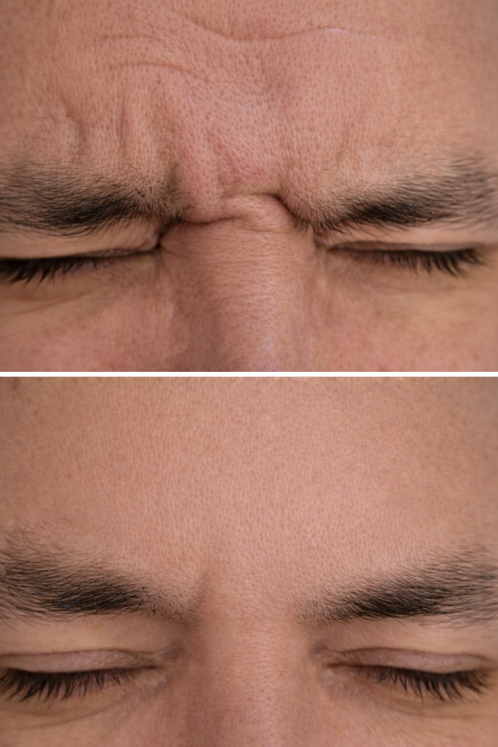 Close-up of a person's forehead before and after Botox treatment softening fine lines and wrinkles for a refreshed, natural look without a frozen appearance.