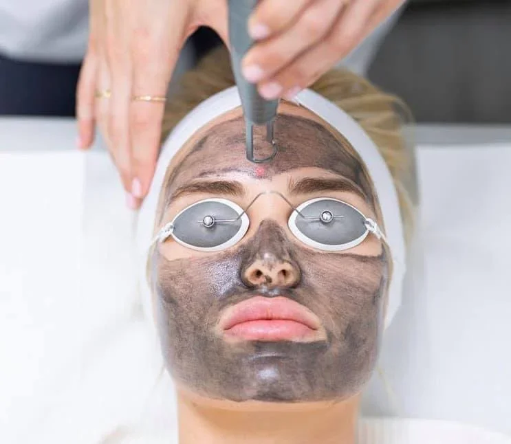 Carbon-Laser-Peel-Treatment.jpeg.webp