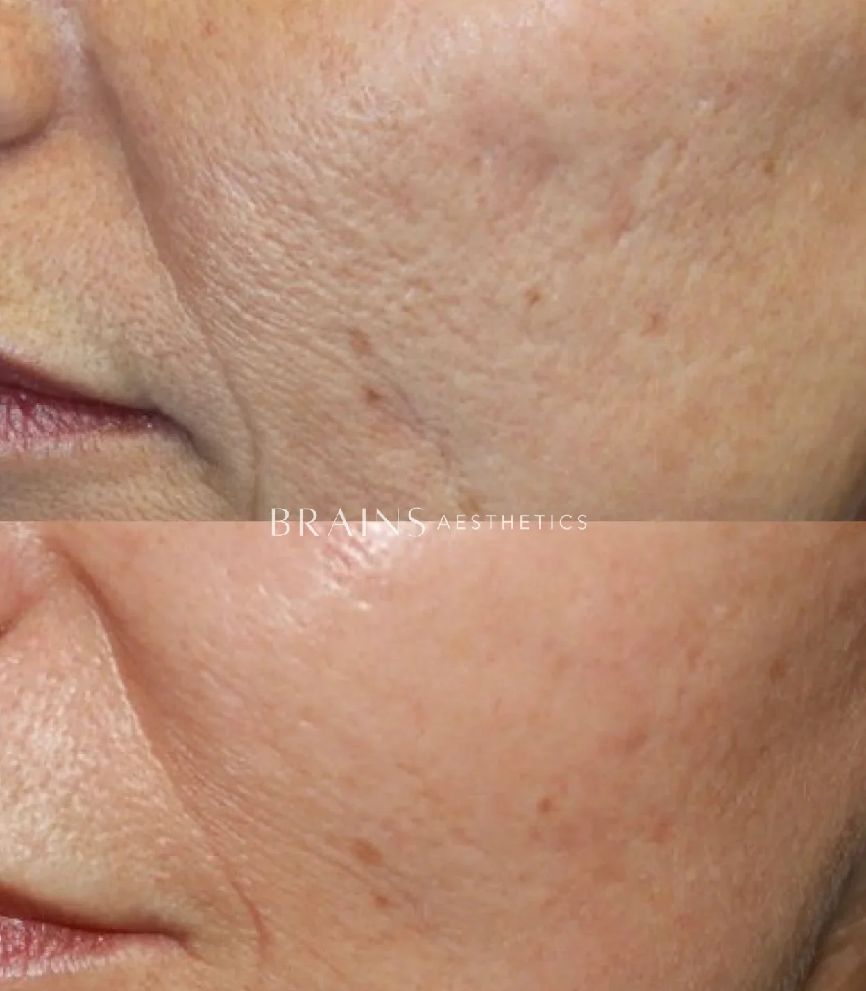 Carbon_Laser_Peel_Before_After_3.png.webp