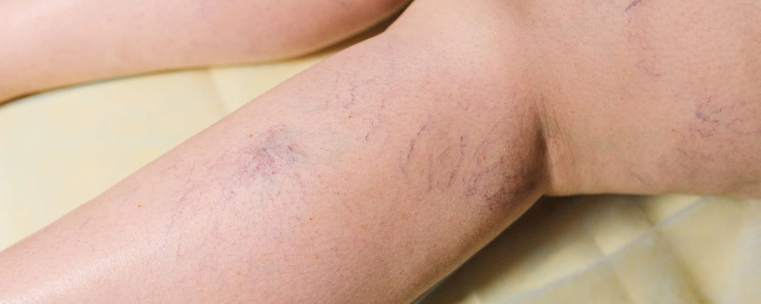 thread-vein-treatment.jpg