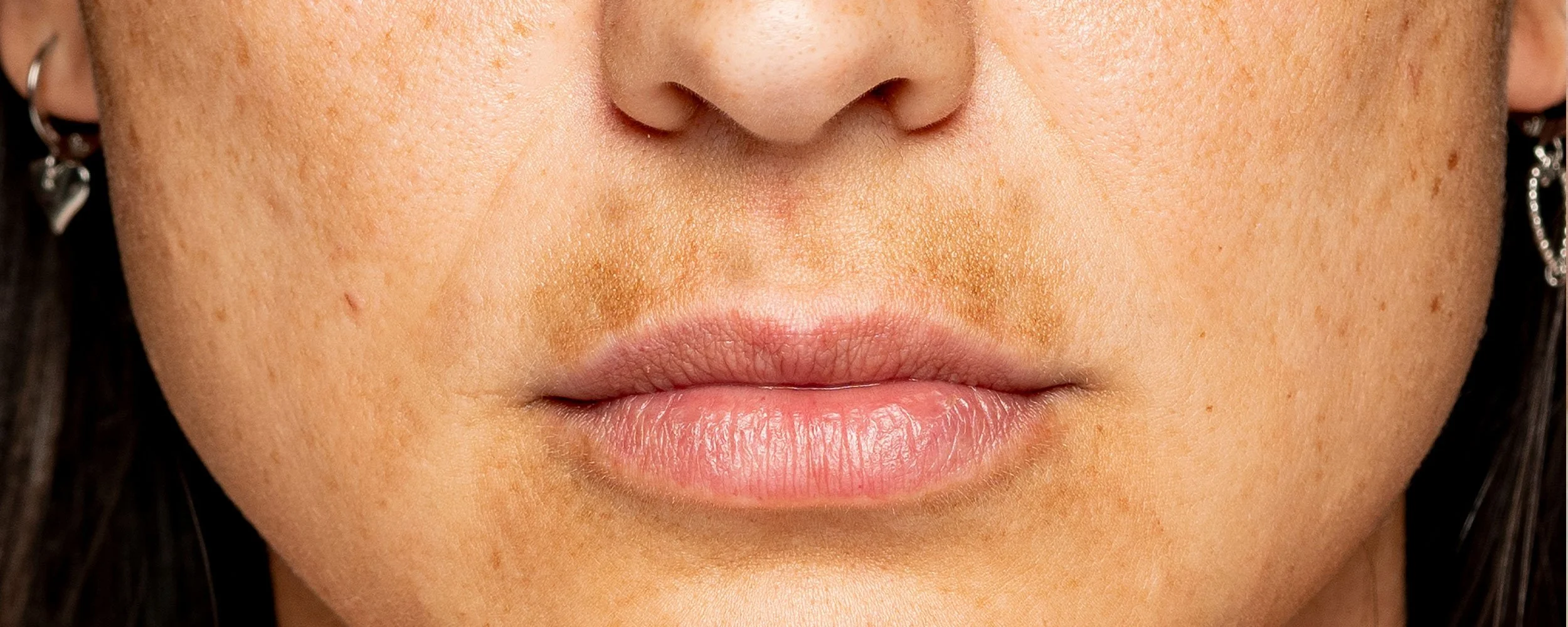 pigmentation-birthmark-treatment.jpg