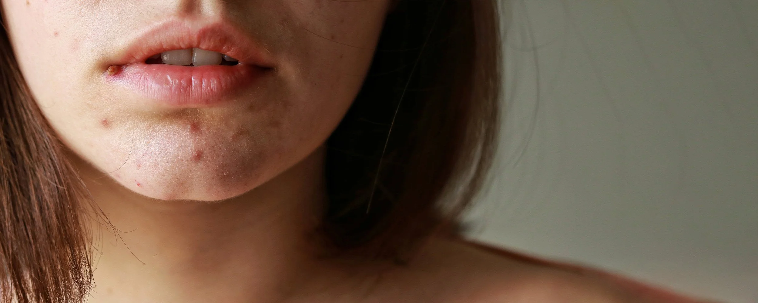 acne-treatment.jpg
