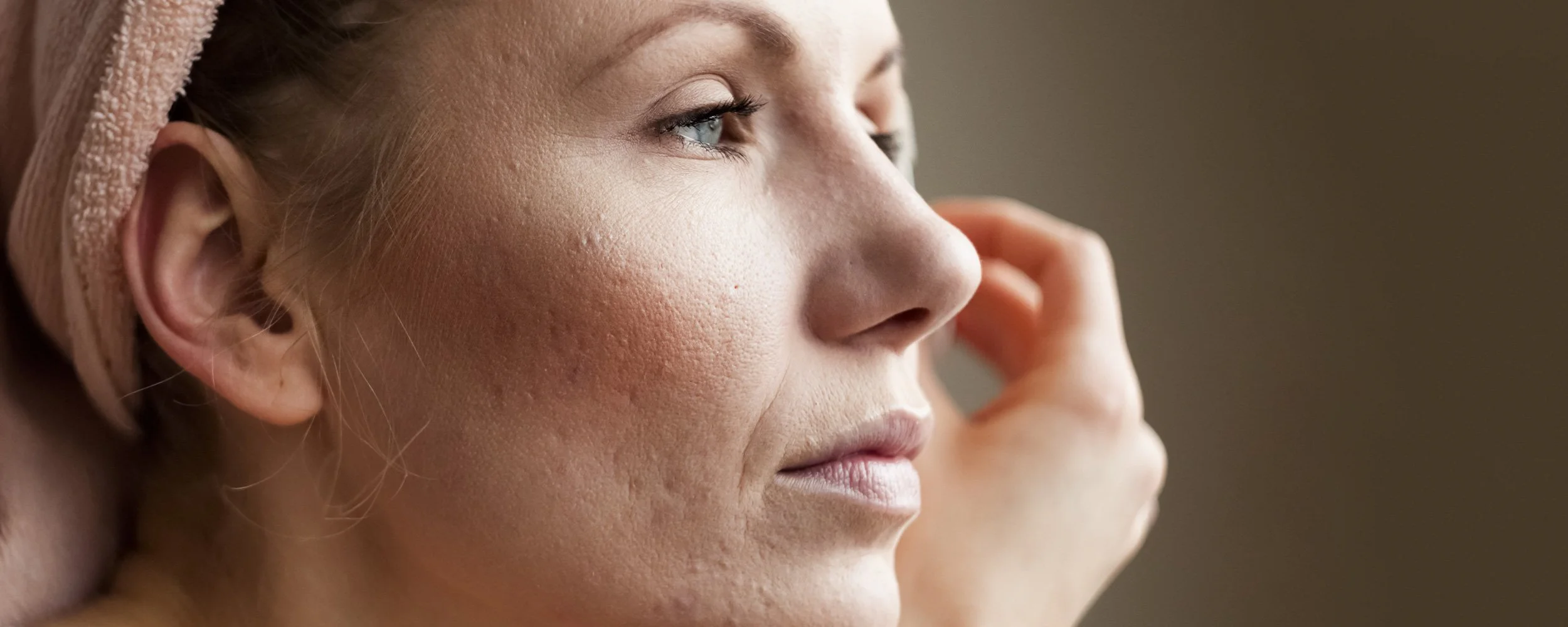 acne-scarring-treatment.jpg