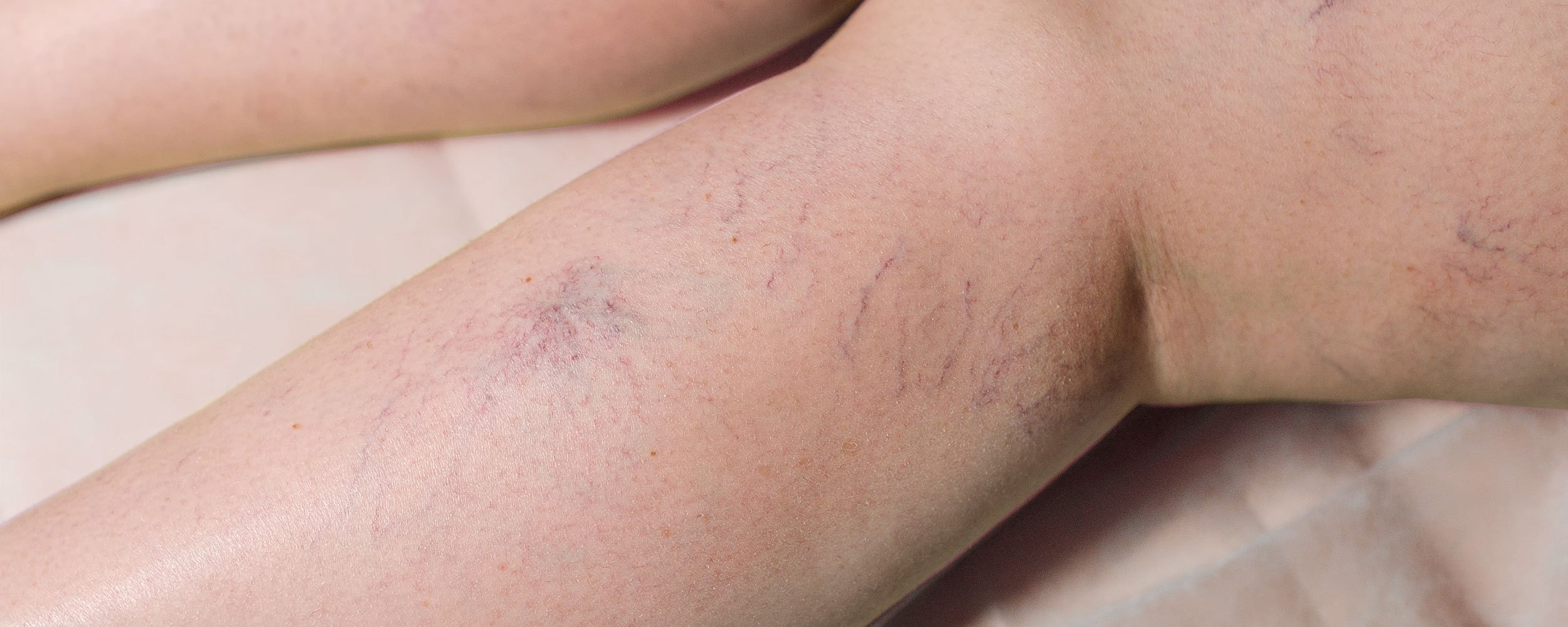thread-vein-treatment-b.jpg