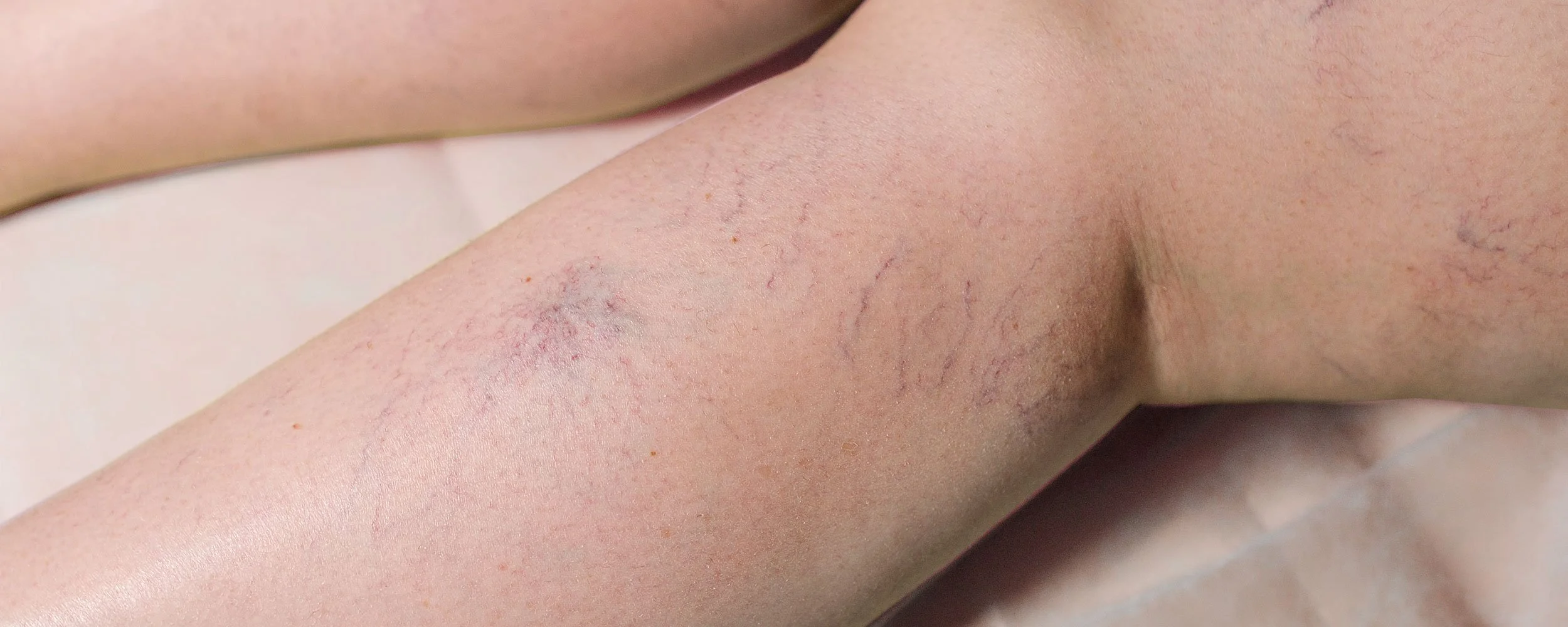 thread-vein-treatment-b.jpg