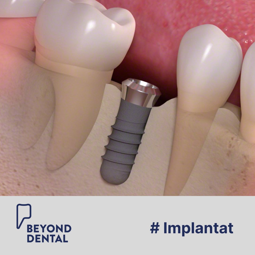 Zahnimplantate sind Schrauben, welche in den Kieferknochen eingebracht werden und wie eine Zahnwurzel funktionieren. Darauf k&ouml;nnen Kronen, Br&uuml;cken und Prothesen verankert werden. Nach dem Einsetzen des Zahnimplantats verbindet sich dieses f