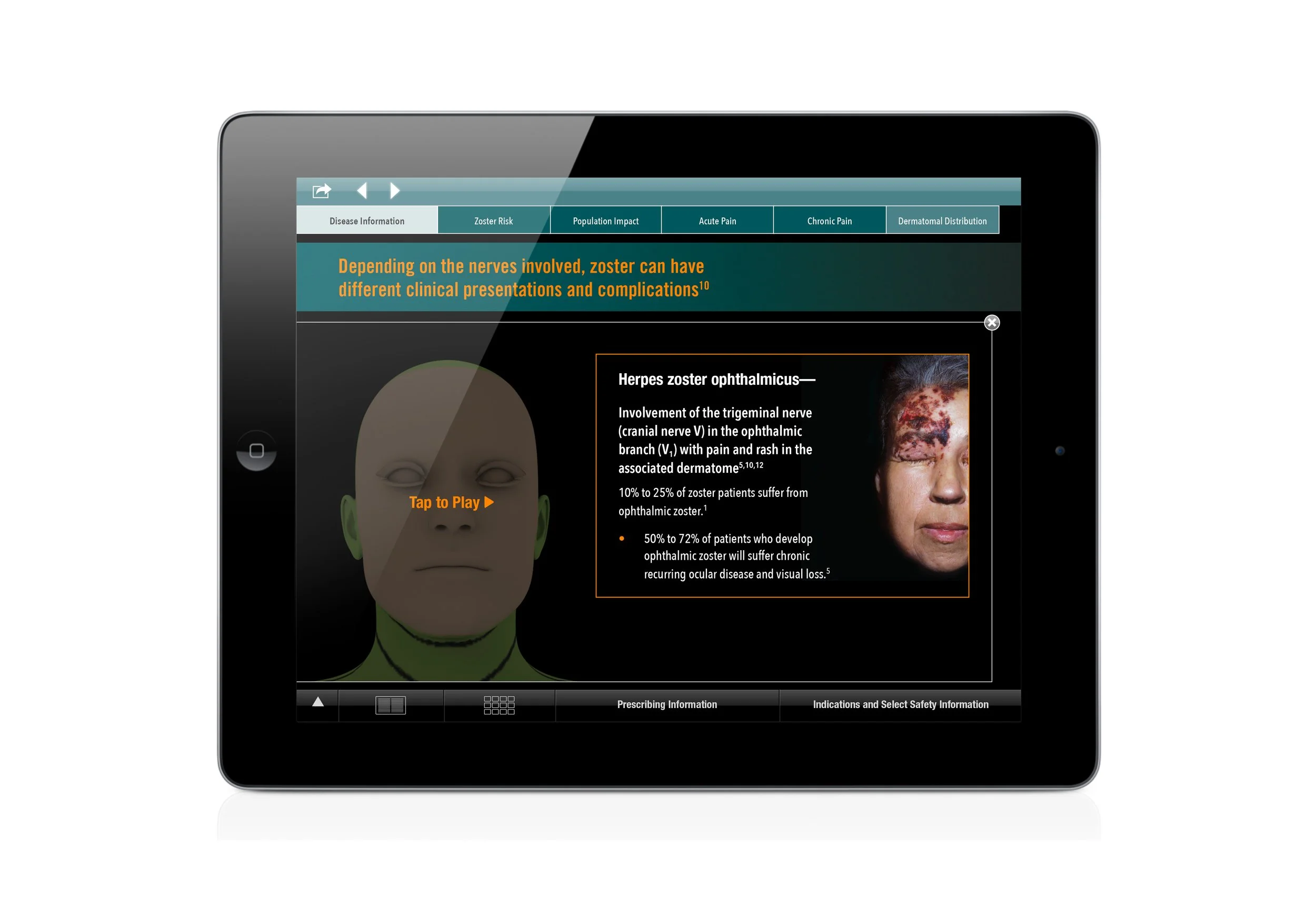 U.S. iPad Tool: Explaining how herpes zoster ophthalmicus involves the trigeminal nerve
in the ophthalmic branch with pain and rash in the associated dermatome.
