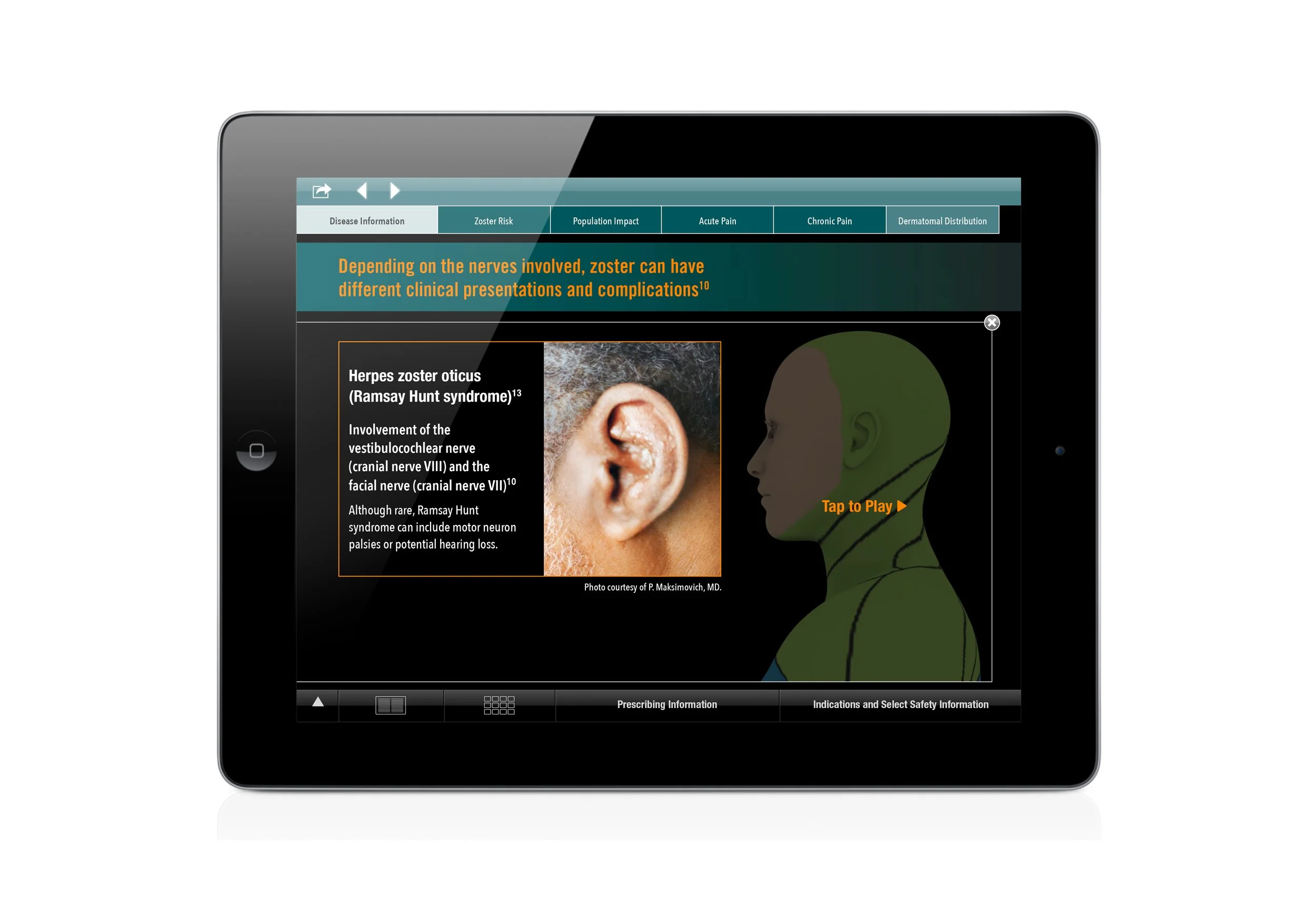 U.S. iPad Tool: Illustrating herpes zoster oticus
and how it affects the vestibulocochlear and facial nerves.