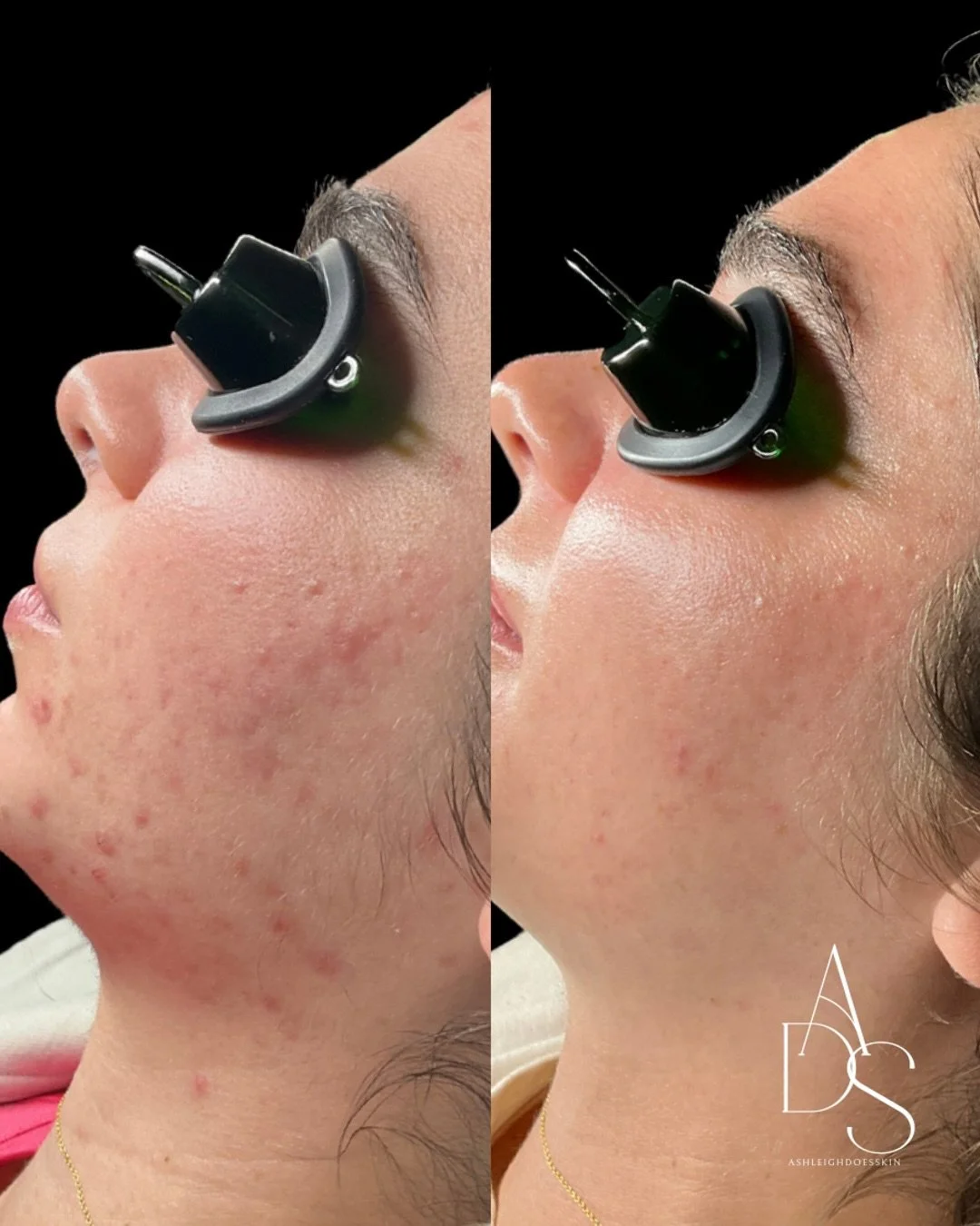Celebrating her clearing and staying clear throughout pregnancy! 

A full Face Reality routine is to thank. 💙

If you&rsquo;re struggling with acne we can help! Book through the link in bio. Not local? 
Book a virtual consult! 💌

&bull;
&bull;
&bul