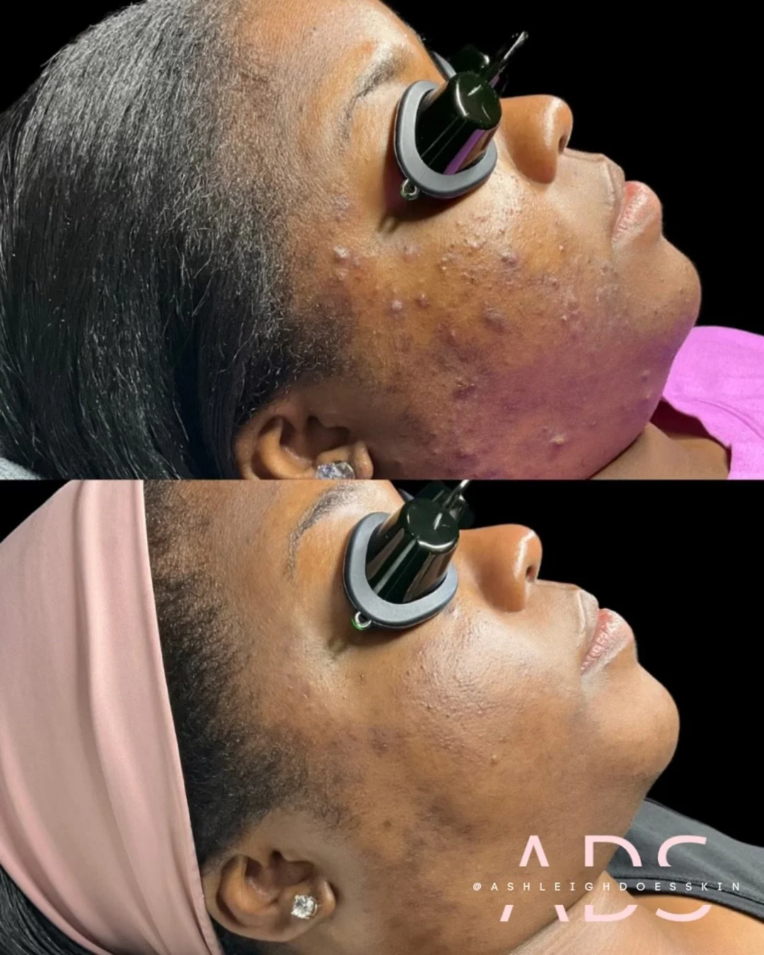 3 month progress &amp; she&rsquo;s not mad about it.✨

What we did-
A touch of barrier repair 
Tailored 😏 home care 
The Perfect Derma Peel 

Now that her breakouts are under control we&rsquo;ll be focusing on lifting the remaining hyperpigmentation