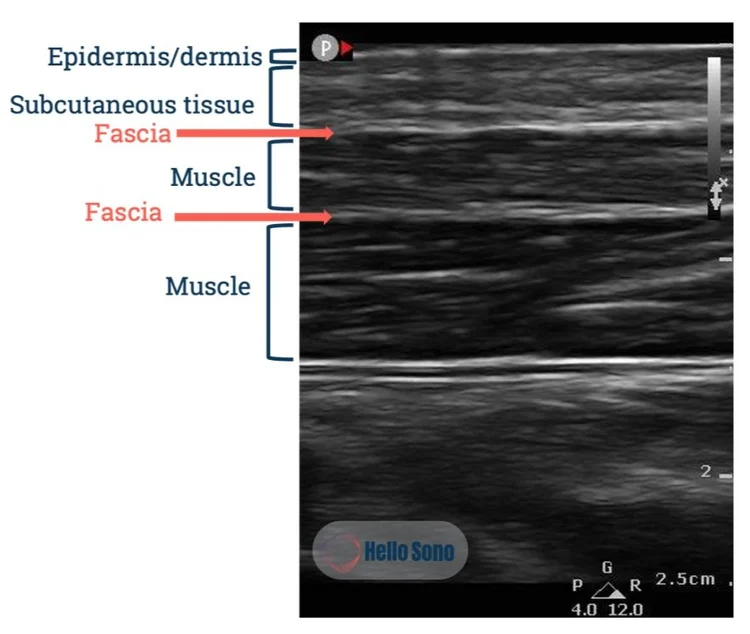 Soft Tissue Infections: How Point-of-Care Ultrasound (POCUS ...