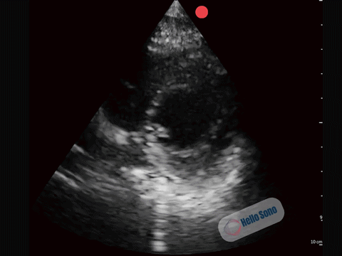 Clip  2: Normal parasternal short-axis view at the level of the papillary muscles.