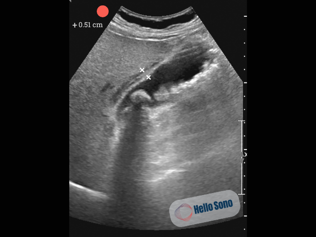 Right upper quadrant ultrasound, with a longitudinal view of the gallbladder. Showing a hyperechoic focus with posterior acoustic shadowing (gallstone) in the back of the gallbladder.