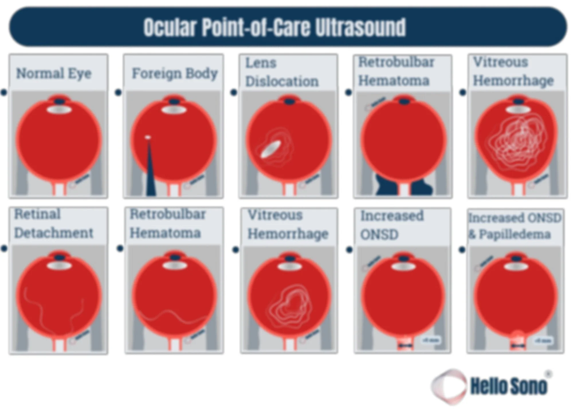 Ocular Point-of-Care Ultrasound Reference Card — Hello Sono