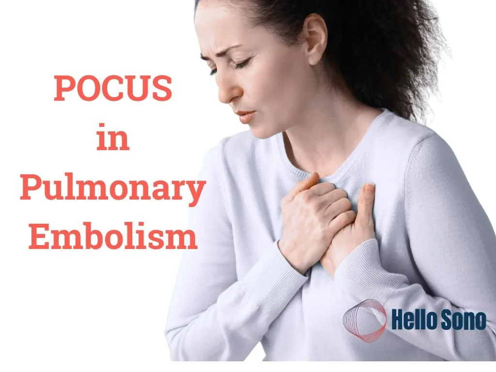 Recognizing Acute Right Heart Strain with POCUS: The D-Sign in Pulmonary Embolism