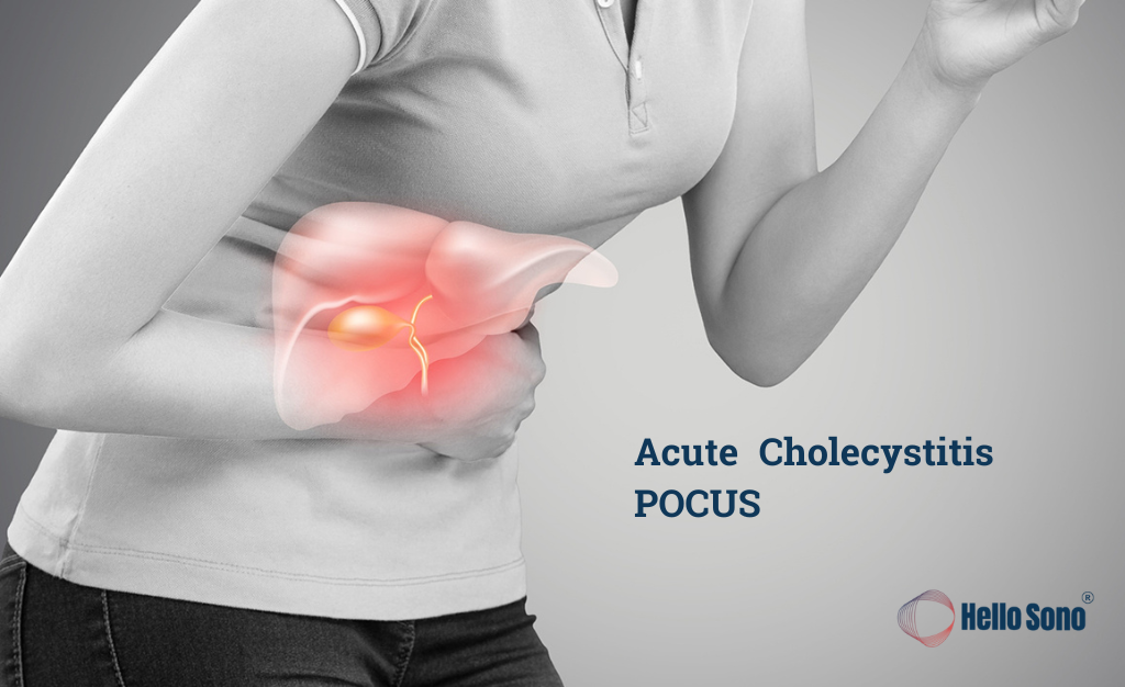 Spotting Acute Cholecystitis on POCUS: What to Look For, What Fools You, and Why it Matters
