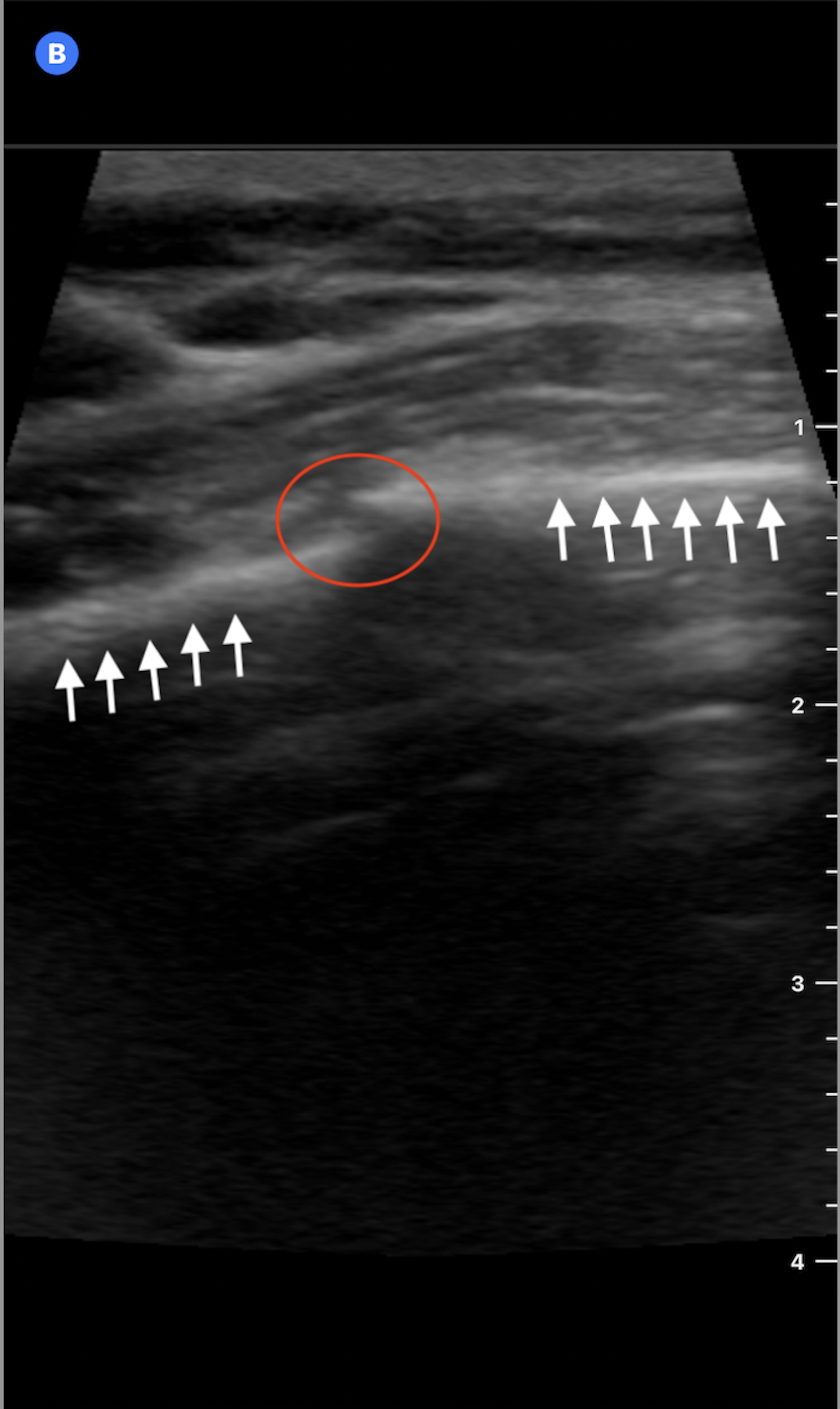 Figure 2: Ultrasound image of the 4th anterior rib in the longitudinal plane shows linear hyperechoic bony cortex (white arrows) with a minimal step-off and discontinuity (red circle) consistent with a nondisplaced rib fracture.