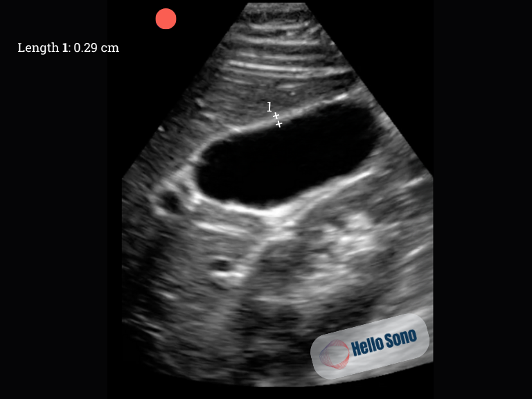 ltrasound of a normal gallbladder in a transverse view