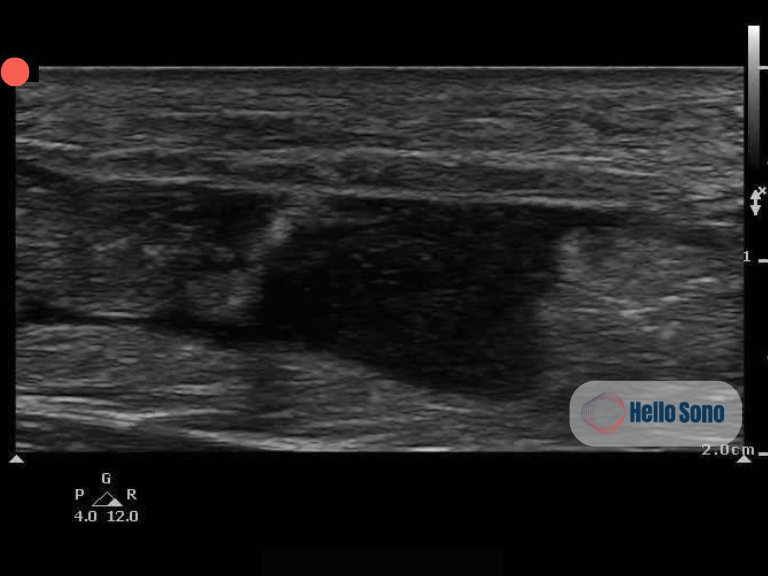 Ultrasound image of Achilles tendon rupture on POCUS>