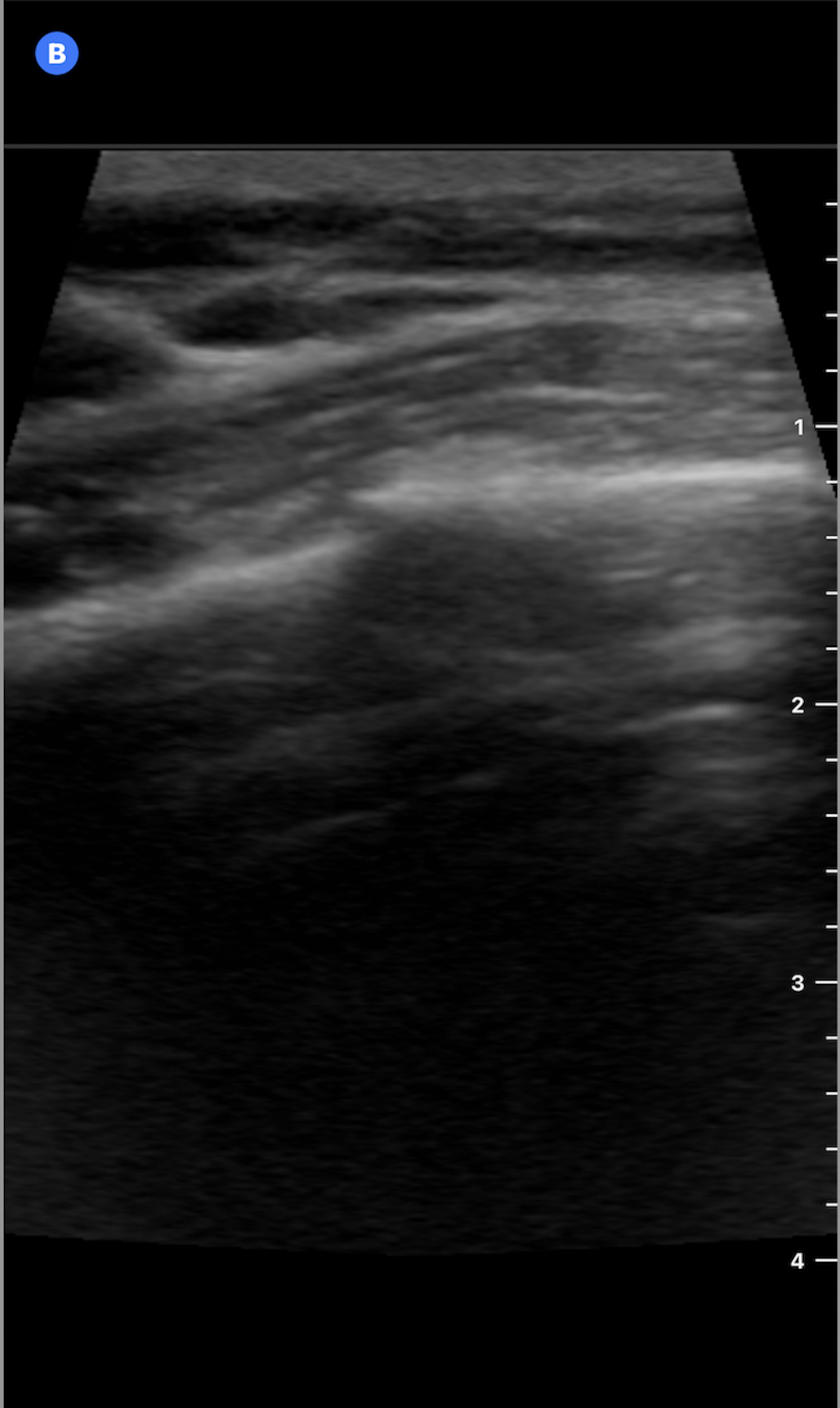 Figure 1: Ultrasound image of the 4th anterior rib in the longitudinal plane without annotation.