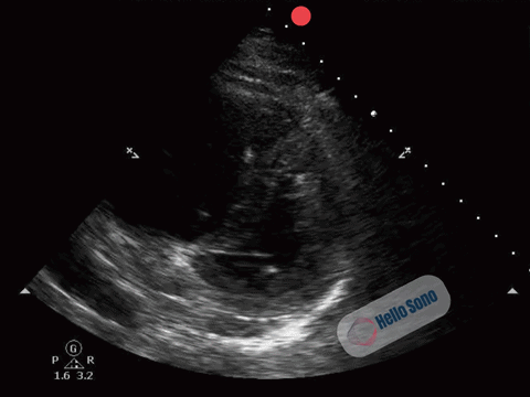 Clip 1: Parasternal short-axis view at the level of the papillary muscles.
