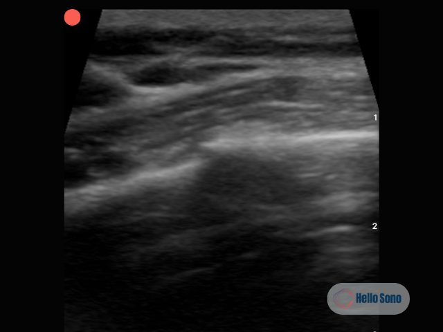 rib ultrasound